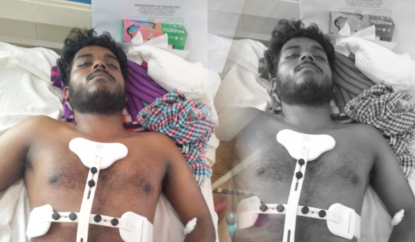 കാട്ടുപന്നി കുറുകെ ചാടി നിയന്ത്രണവിട്ട ബൈക്ക് മറിഞ്ഞ് യുവാവിന് ഗുരുതര പരിക്ക്